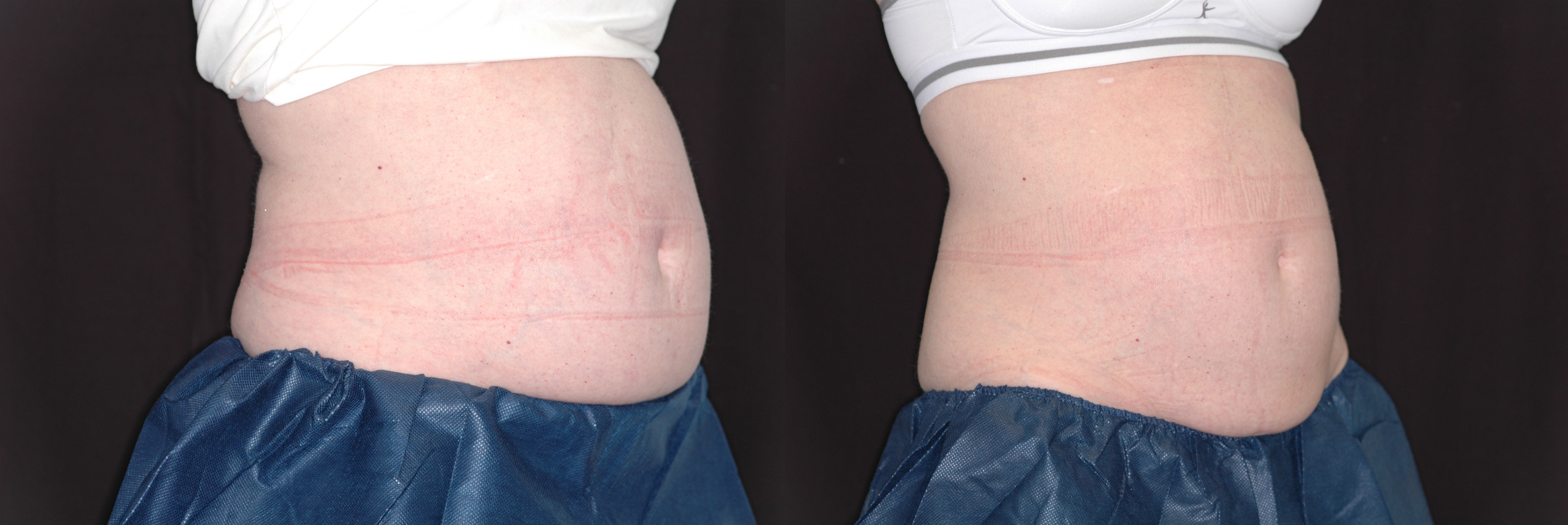 Zeltiq, before and after photos, Dr. Steve Weiner, Destin, Florida, Abdomen